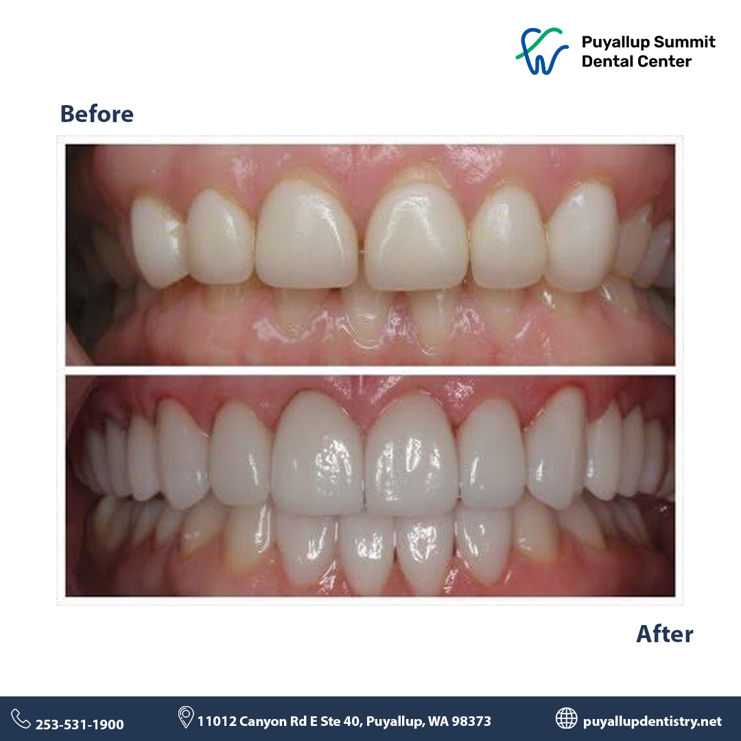 Best Dental Results Puyallup Dentistry